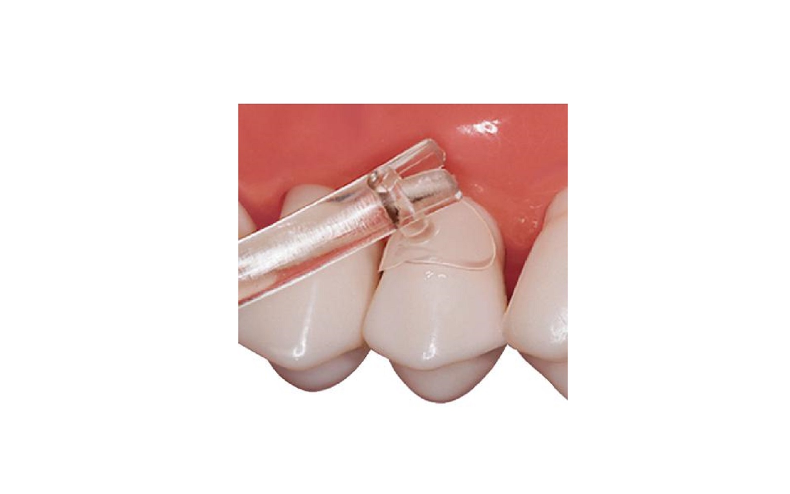 Cure-Thru® Clear Cervical Matrices, Assorted Package