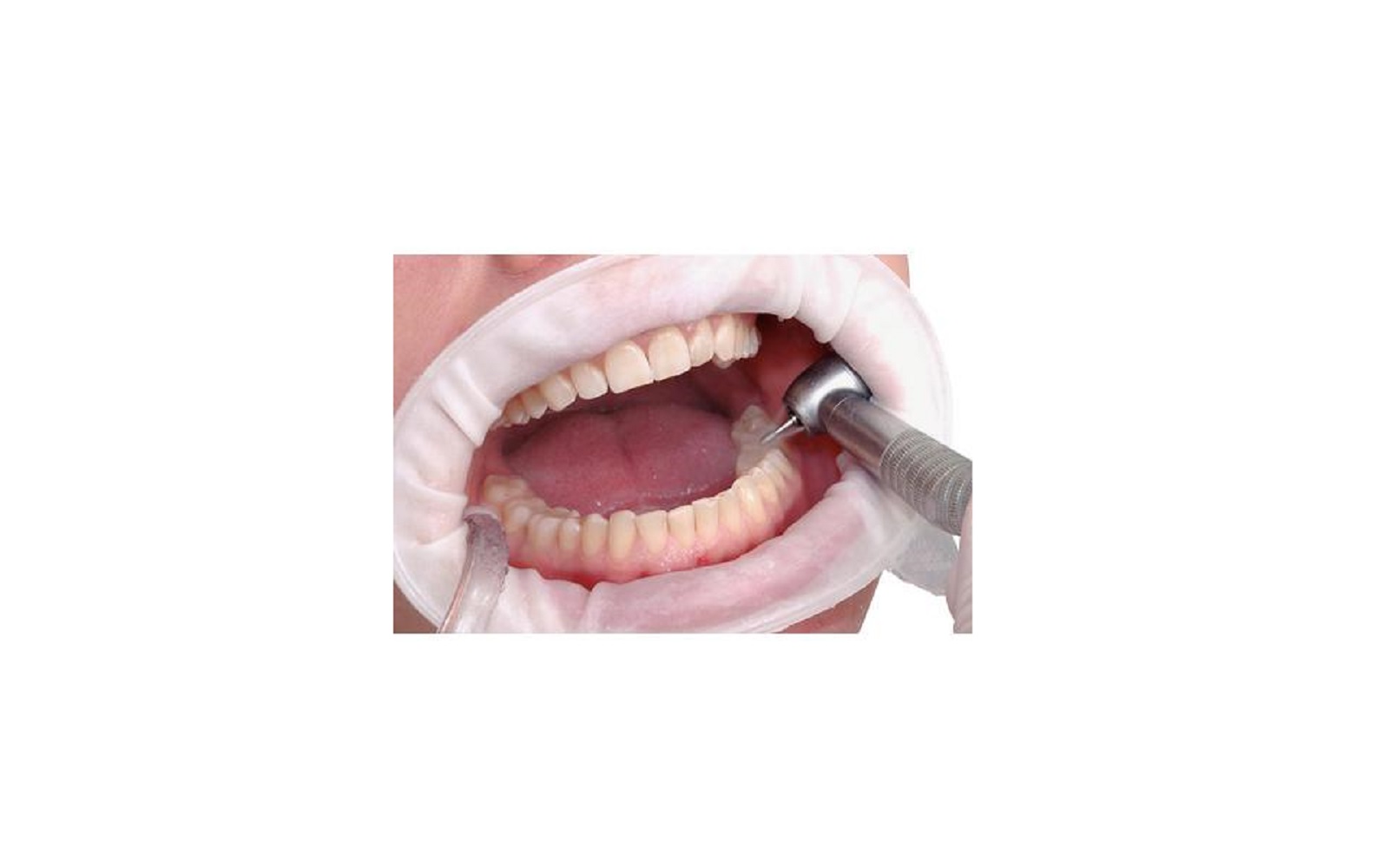 OptraGate® ExtraSoft Lip and Cheek Retractors – Refill, 80/Pkg - Junior