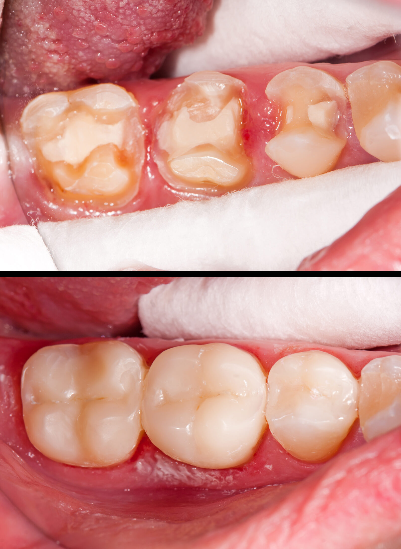 before and after of porcelain inlays and onlays on molars