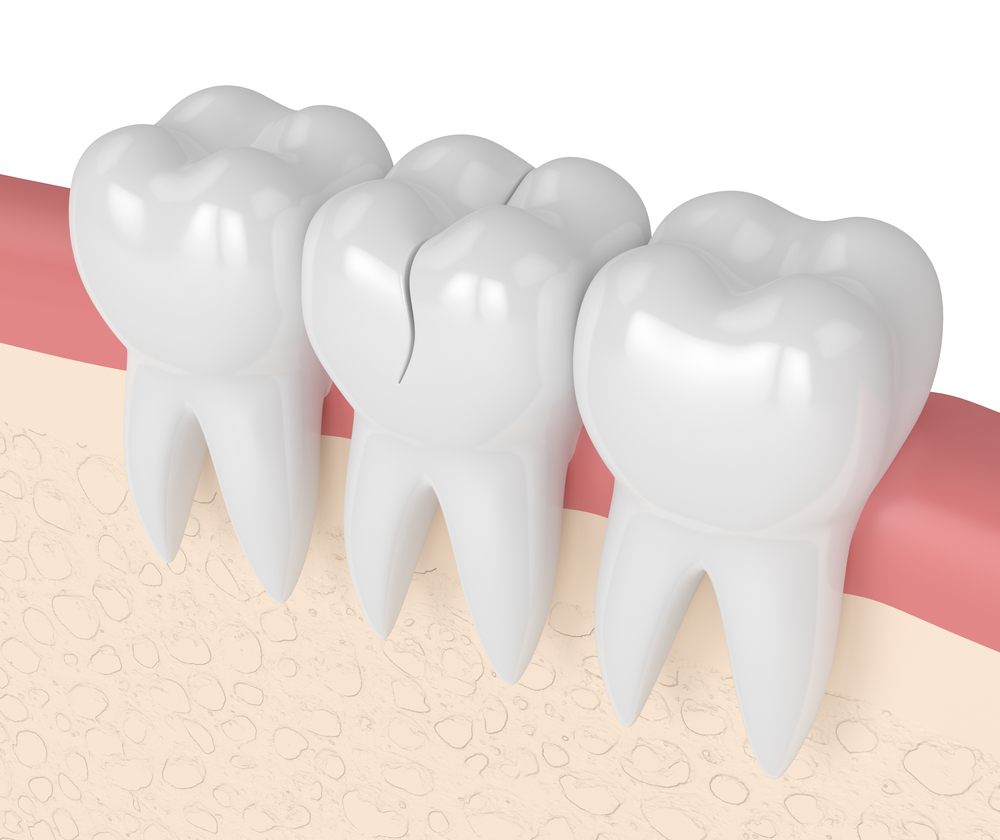 cracked tooth