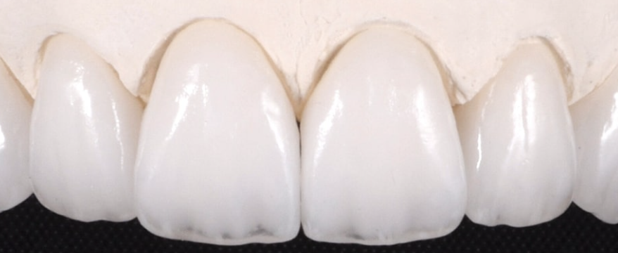 upper front teeth closeup