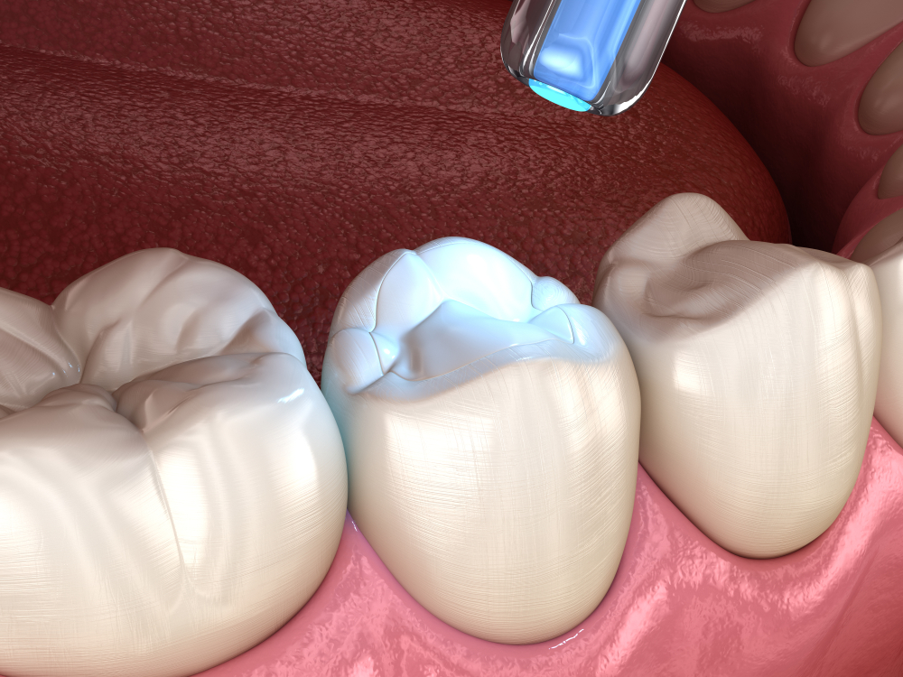 tooth filling is hardened with a handheld light