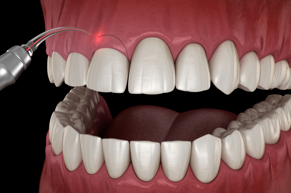 gingivectomy illustration